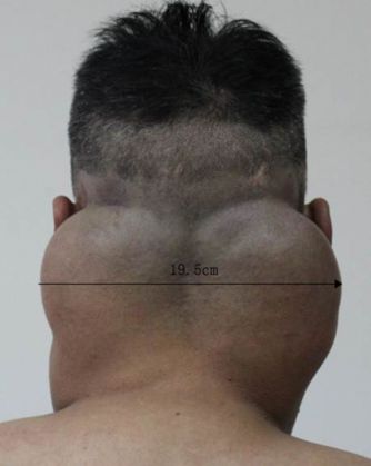 Man-in-Guangzhou-in-China-suffering-from-Madelung-disease1_1
