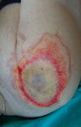 BRAȘOV. Mutilat de artificii! Atenție! Imagini care vă pot afecta emoțional 3 mutilat de artificii2_201662.jpg