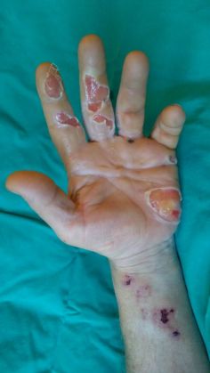 BRAȘOV. Mutilat de artificii! Atenție! Imagini care vă pot afecta emoțional 5 mutilat de artificii3_201664.jpg