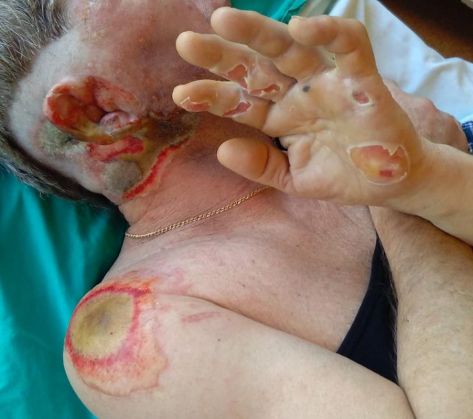 BRAȘOV. Mutilat de artificii! Atenție! Imagini care vă pot afecta emoțional 2 mutilat de artificii_201661.jpg