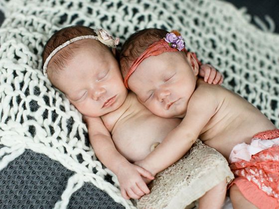 identical-twins-born-holding-hands-jenna-jillian-sarah-thist