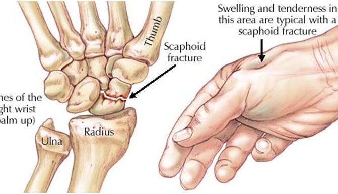 Cât e de gravă accidentarea Sorinei Târcă. Explicații medicale 2 fractura-scafoid-1.jpg