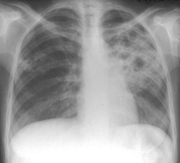 Brașov. 24 martie - Ziua Mondială a Tuberculozei 6 article_250959_1.jpg