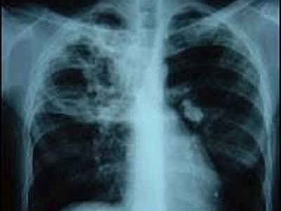 ÎN SFÂRȘIT! Avem o strategie pentru eradicarea tuberculozei în România 1 article_426685_1.jpg