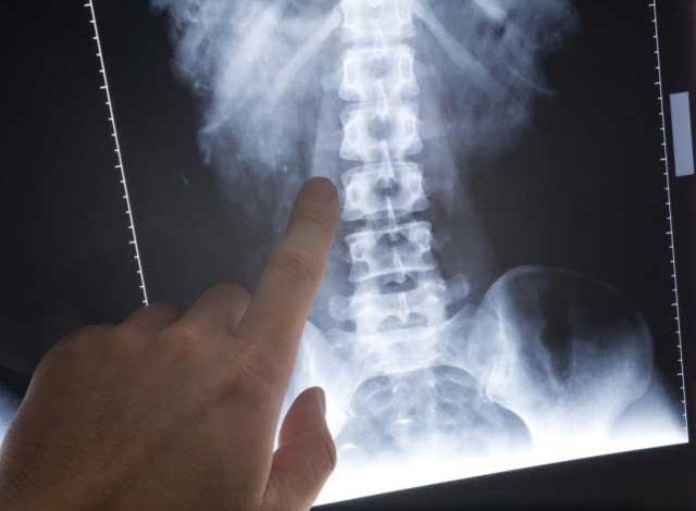 Burta strică... spatele! 1 coloanavertebrala.jpg