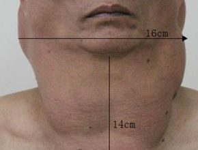 Man-in-Guangzhou-in-China-suffering-from-Madelung-disease_19
