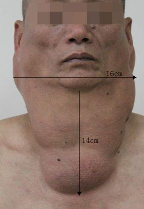 Man-in-Guangzhou-in-China-suffering-from-Madelung-disease_19