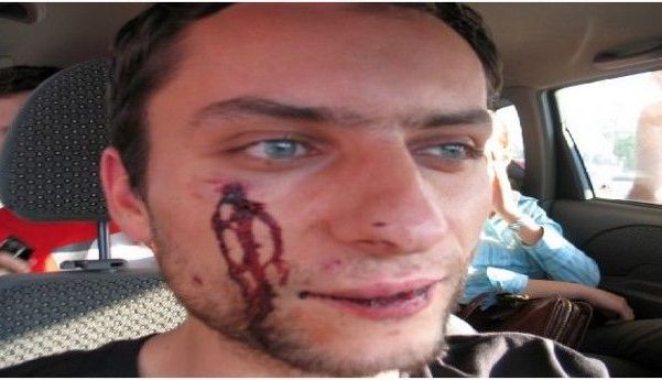 Bărbat bătut de poliţişti! România, condamnată la CEDO pentru acest caz! 1 batut.jpg