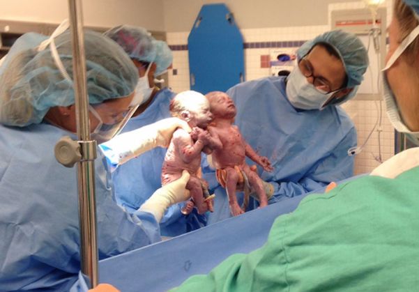 EMOȚIONANT. Uite cum arată acum gemenele care s-au născut ținându-se de mână 1 identical-twins-born-holding-hands-jenna-jillian-sarah-thist