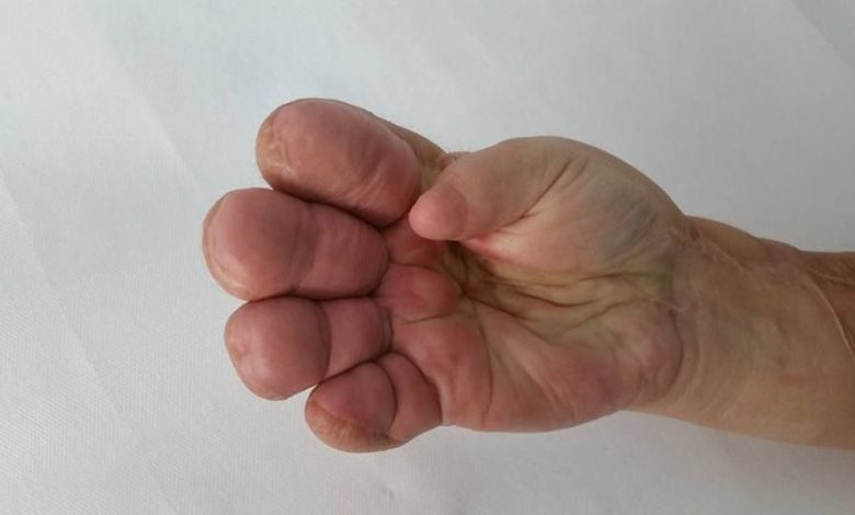 Update BRAŞOV. „Reexpertizare” medicală din condei. Femeia cu mâna nefuncţională se poate pensiona 1 mna1.jpg