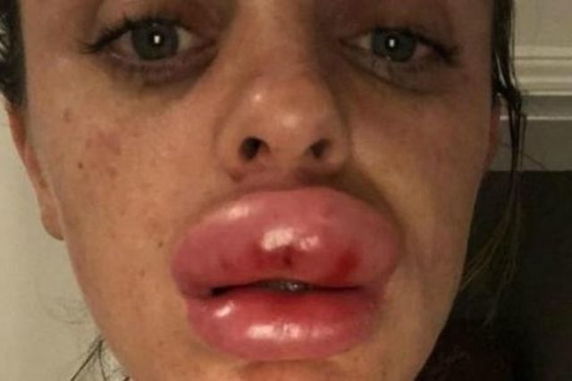 HORROR. Buza i-a ajuns la nas!!! 1 buye.jpg