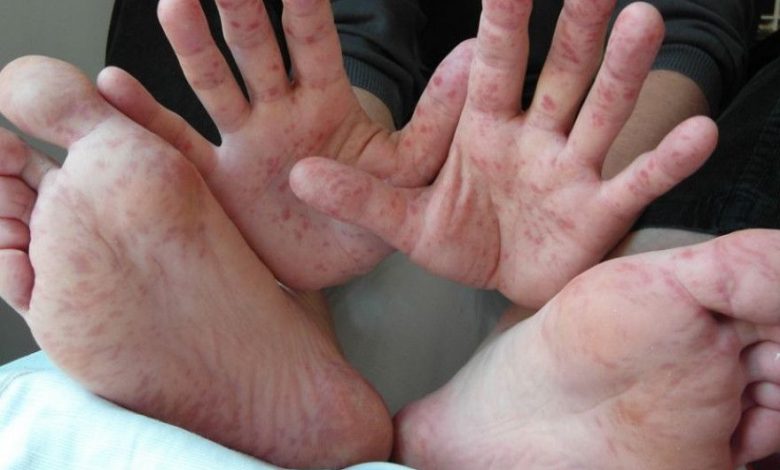 Încă o adolescentă diagnosticată cu meningită a decedat 1 meningita.jpg