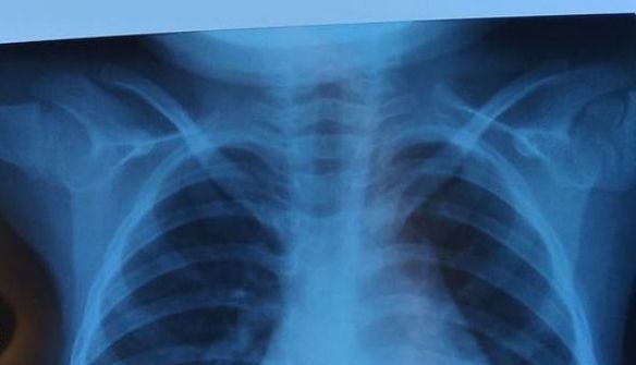 ALERTĂ. PERICOL. Ne pregătim de o PANDEMIE NECRUȚĂTOARE. Noul coronavirus din China s-ar putea răspândi la nivel mondial 1 pneumonie.jpg