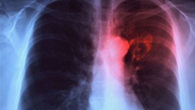 pneumonie_2.jpg