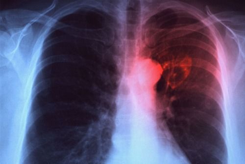 BRAȘOV. Pneumonia e noua amenințare. Creștere fulminantă a numărului de îmbolnăviri 1 pneumonie_2.jpg