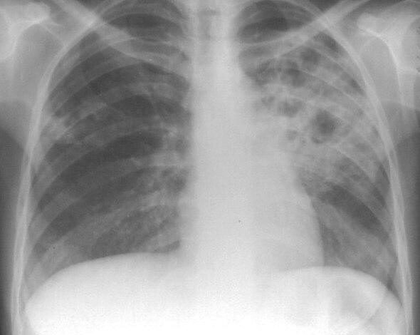 Brașov. 24 martie - Ziua Mondială a Tuberculozei 5 | MyTex.ro