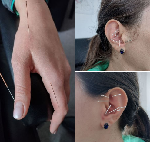 BRAȘOV. Vindecare prin acupunctură și cupping (ventuze) 3 | MyTex.ro