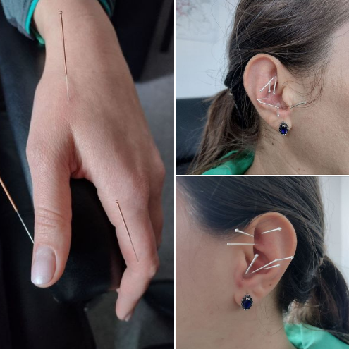 acupunctura.png