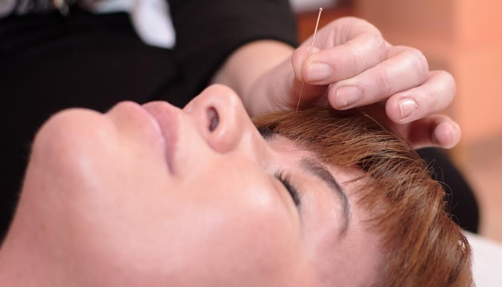 Vindecare cu acupunctură și cupping (ventuze) 5 | MyTex.ro