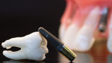 implant | MyTex.ro