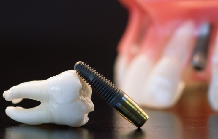 Când este necesar un implant dentar? 3 | MyTex.ro