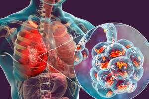 Pneumonia a băgat 105 brașoveni în spital | MyTex.ro