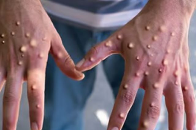 Un prim caz de mpox, confirmat în Suedia  3 Un prim caz de mpox | MyTex.ro