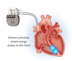Implant salvator pentru pacienții cu insuficiență cardiacă | MyTex.ro