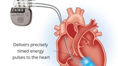 Implant salvator pentru pacienții cu insuficiență cardiacă | MyTex.ro