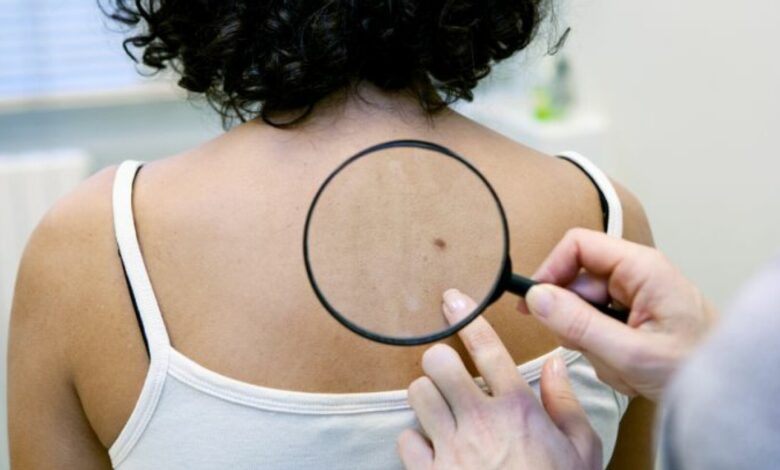 Care sunt primele semne ale cancerului de piele 3 Primele semne | MyTex.ro