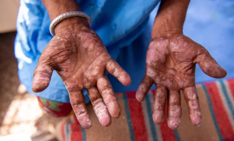 Maseuză de origine asiatică, diagnosticată cu lepră! Alte trei cazuri sunt în evaluare - Ministerul Sănătății, anunț de ultimă oră 3 Lepră | MyTex.ro