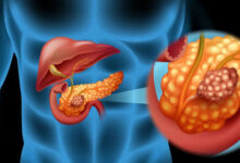 Descoperire revoluționară: AI poate depista cancerul de pancreas cu peste un an înainte de diagnostic 5 Gripa face ravagii | MyTex.ro