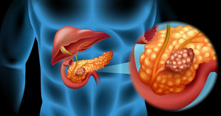 Descoperire revoluționară: AI poate depista cancerul de pancreas cu peste un an înainte de diagnostic 3 Pancreas | MyTex.ro